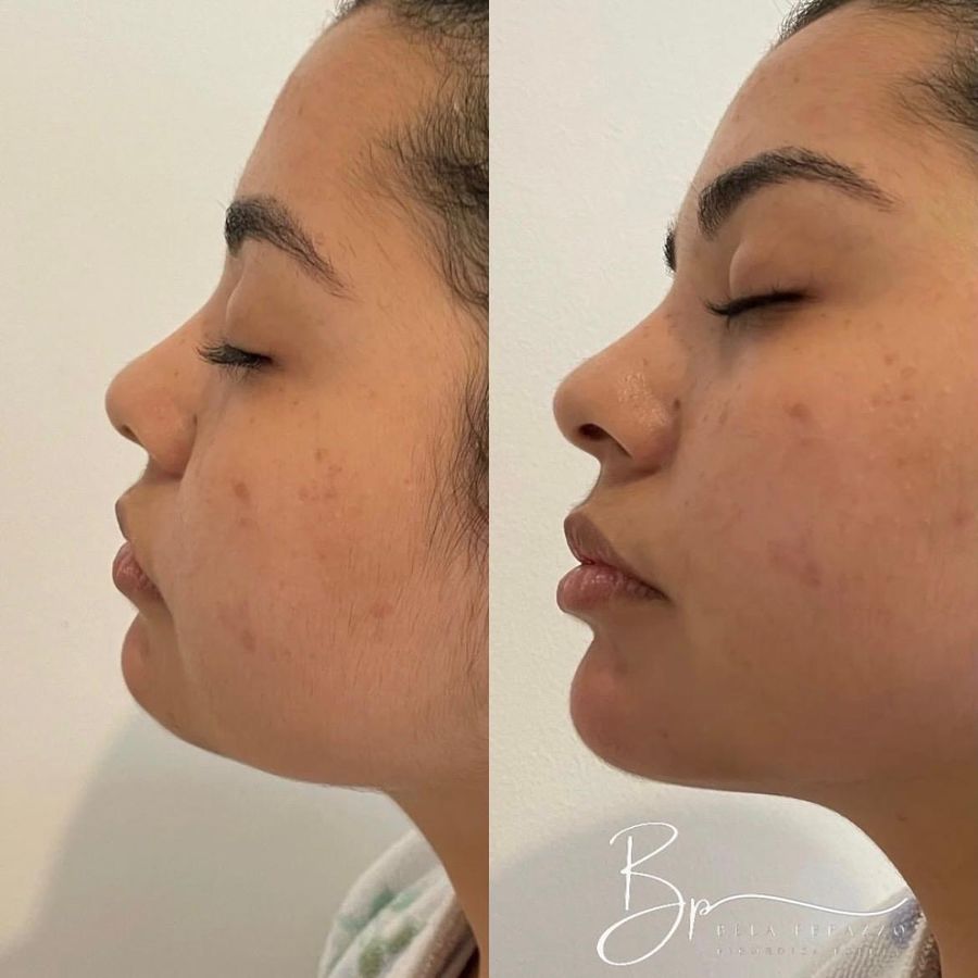 Antes e depois: perfil do rosto