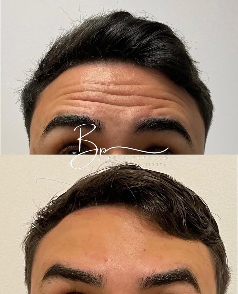 Antes e depois: região da testa